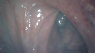 アナル内部　内視鏡　クスコ　直腸